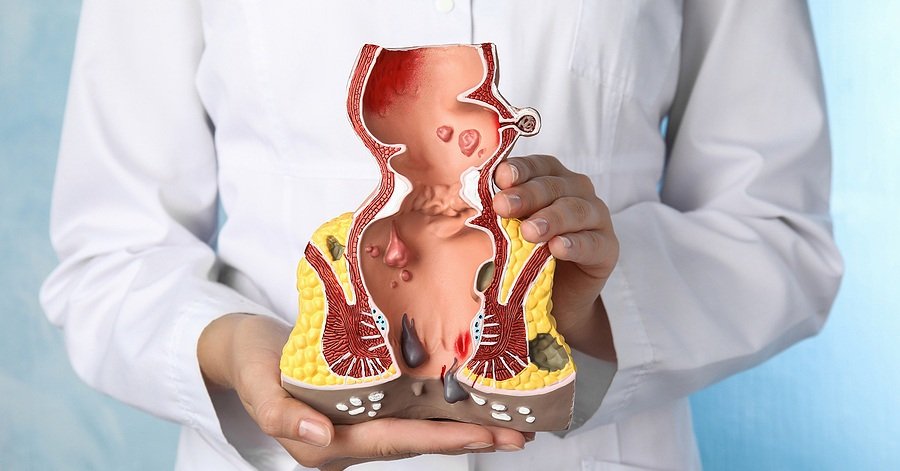 Hemorrhoid Treatment